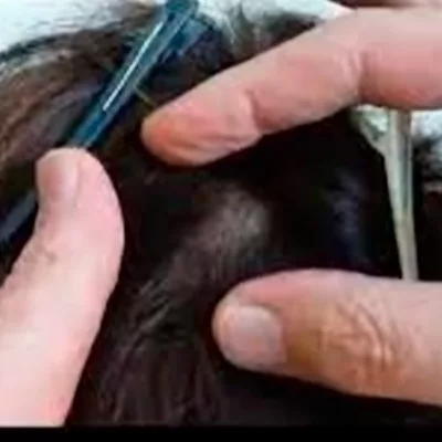 Reparo de protese capilar